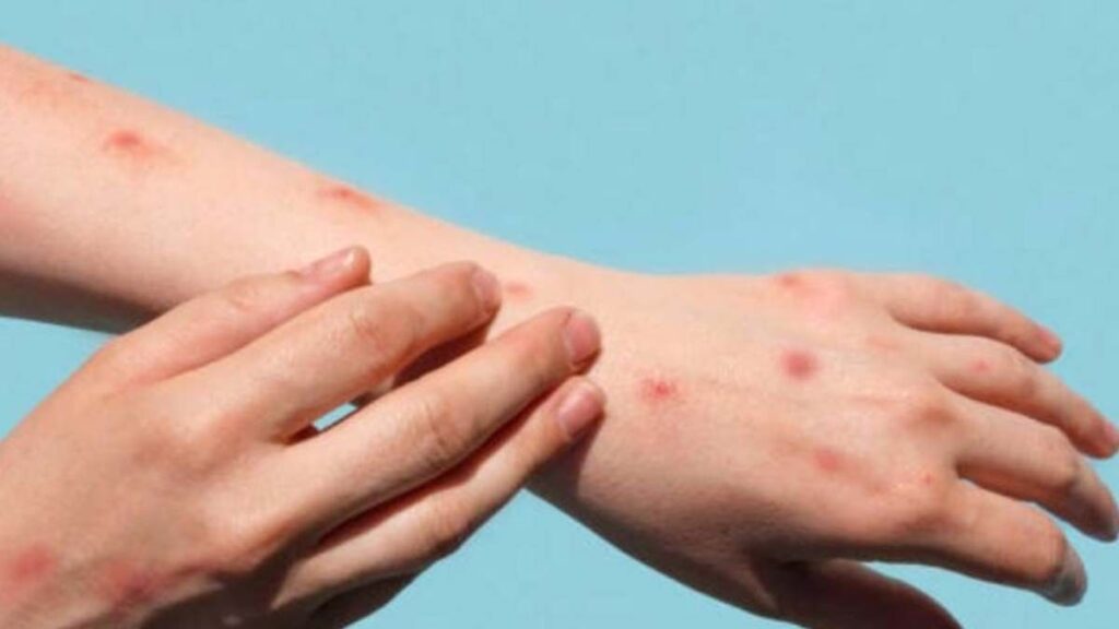 धुळे जिल्ह्यात मंकी पॉक्सचा पहिला रुग्ण
